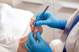 Verwijderen likdoorn